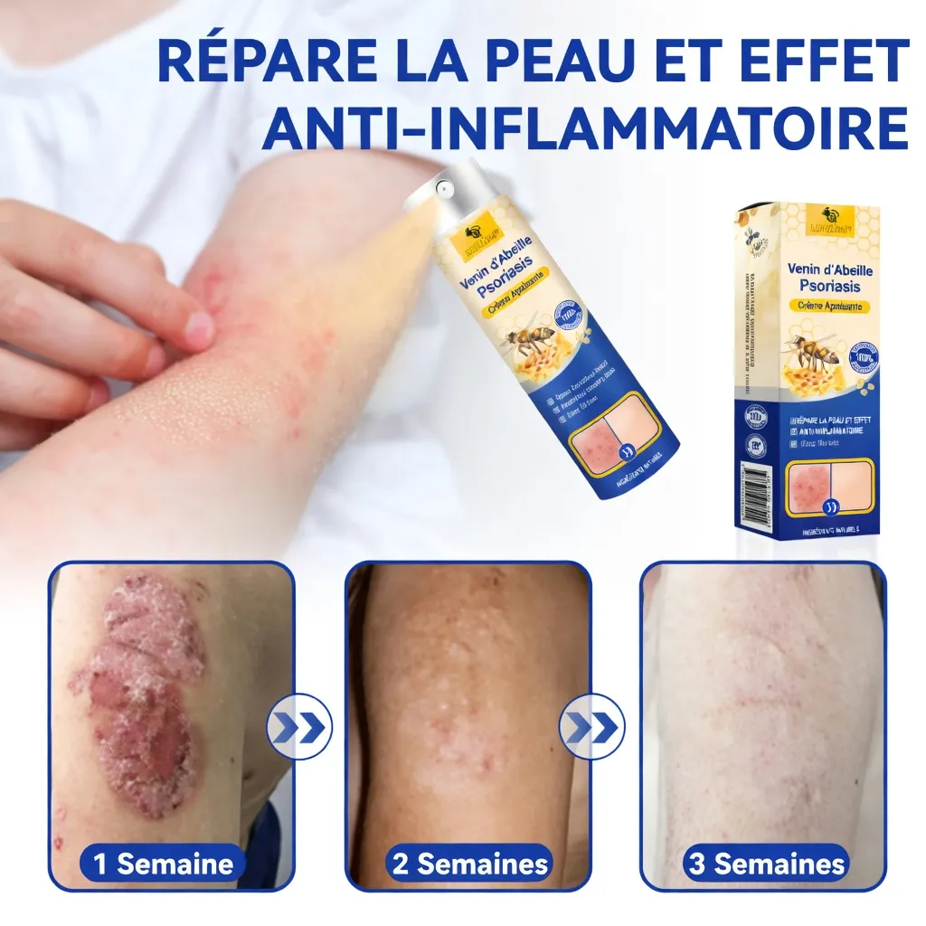 Spray psoriasis